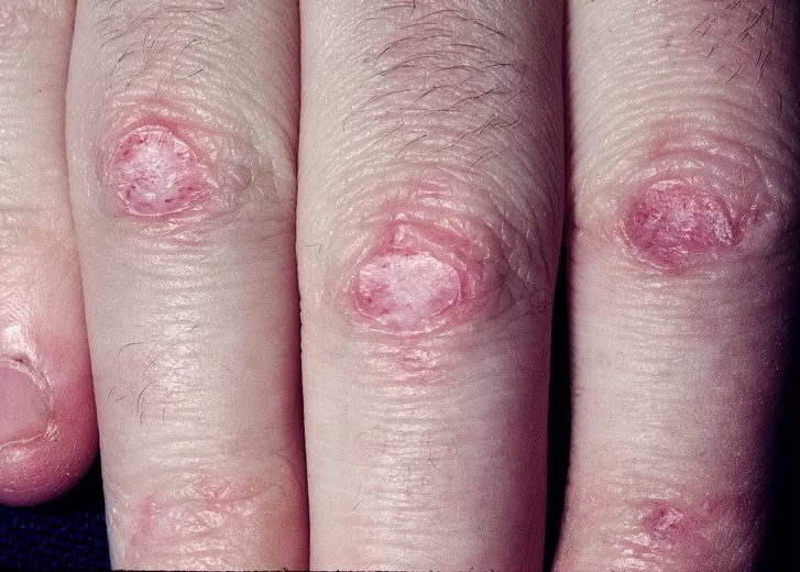 Persoonlijke oedeemtherapie bij Fysiomix Deurne.