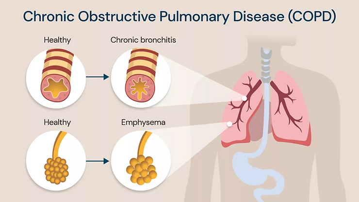 Fysiotherapie bij COPD in Fysiomix Deurne.
